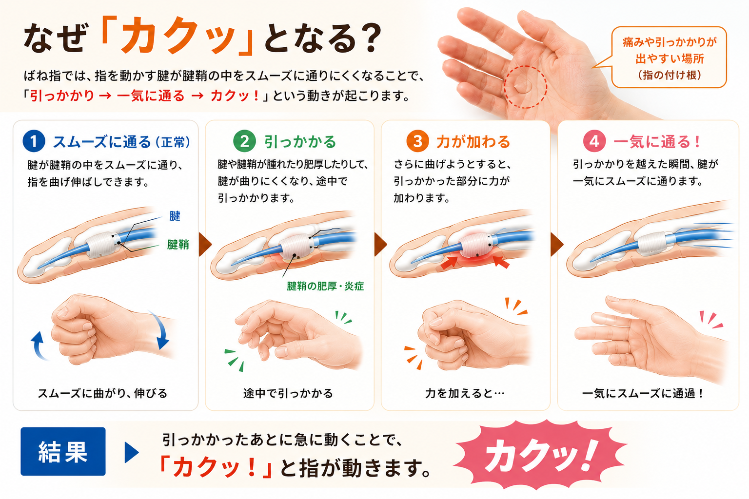 ばね指で指がカクッと引っかかる仕組み
